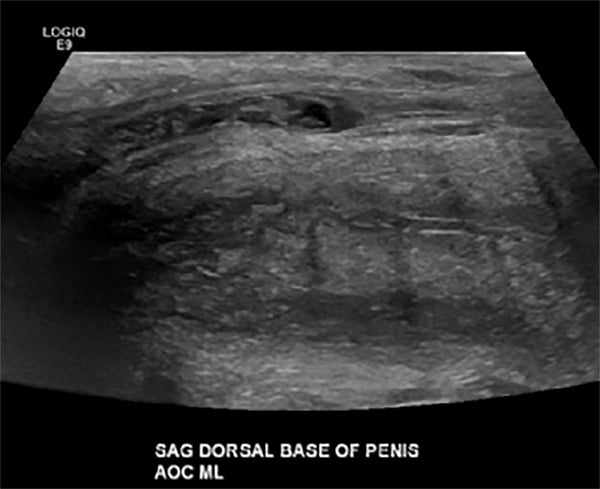 46-6 Genitourinary - Penile Mondor - figure 2.jpg