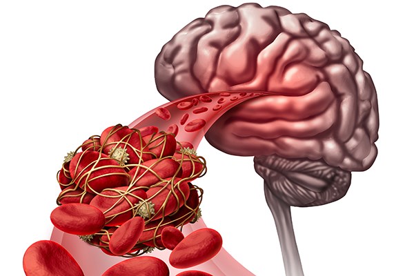 thrombosis in the brain emra