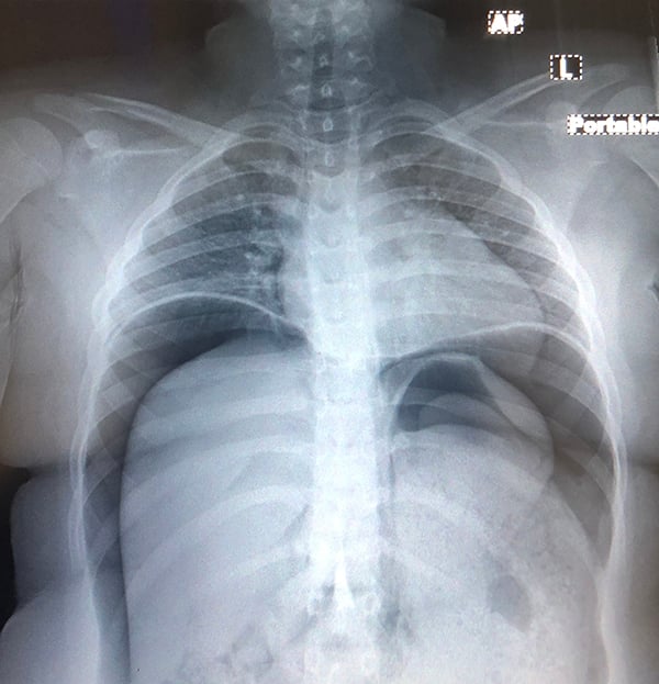 Gastric Perforation after Liquid Nitrogen Ingestion A