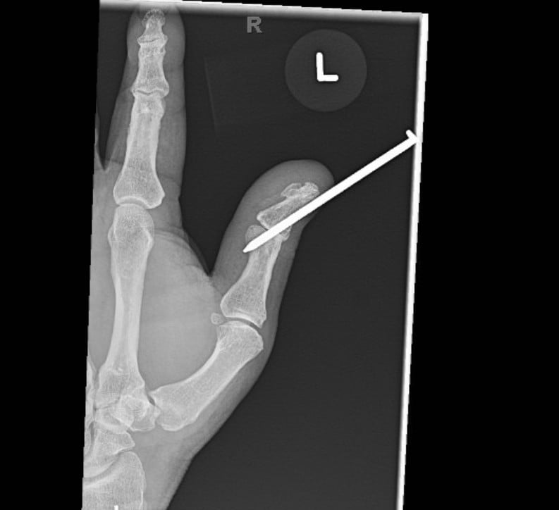 Nail Removal x-ray 1.jpg