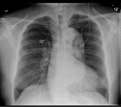 Chest x-ray demonstrating the typical finding of a widened mediastinum. 
