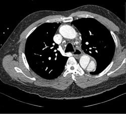 CT angiogram of the chest revealing a Stanford type B, Debakey type IIIb descending aortic dissection.
