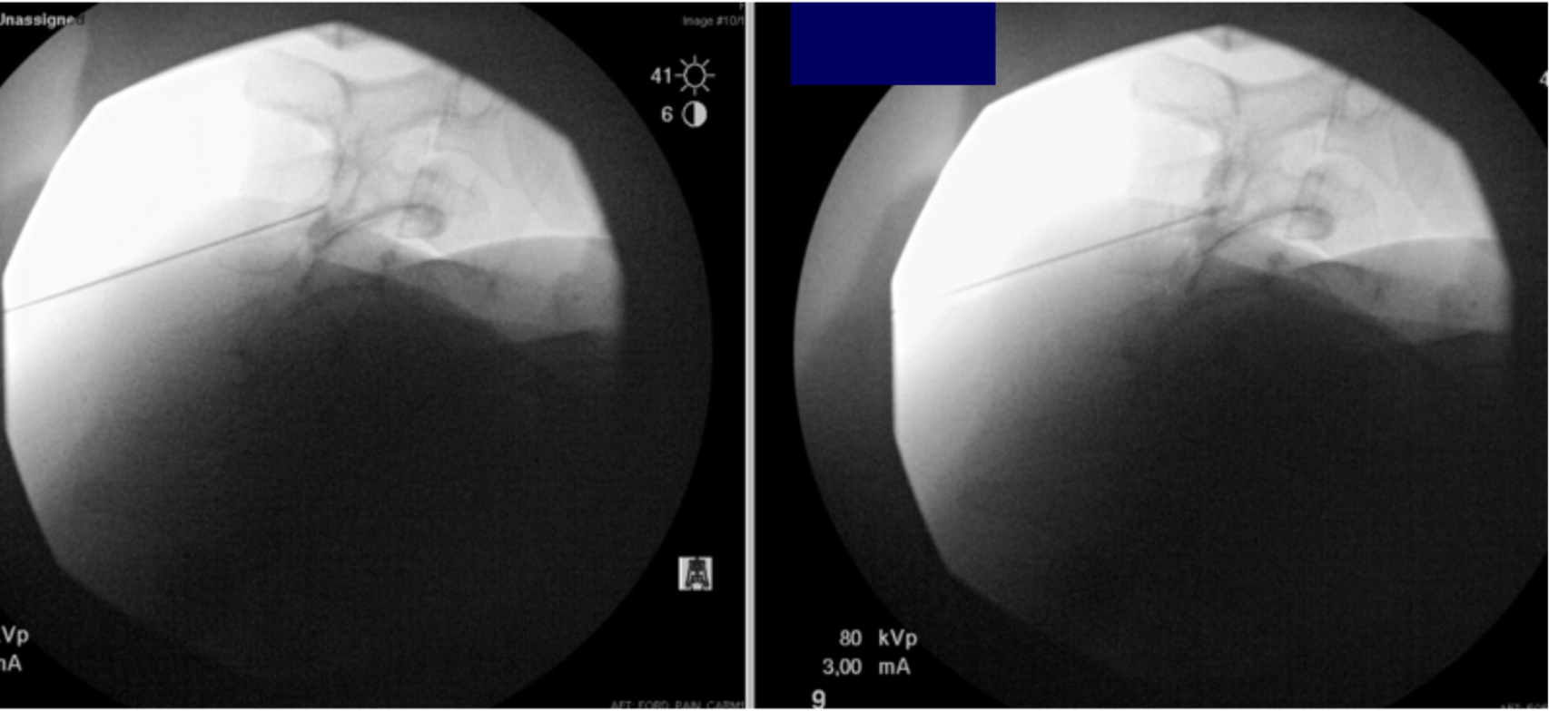 Pseudo SAH - cervical medial branch block.png