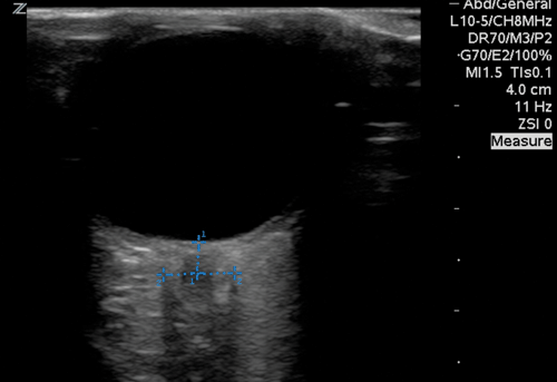 Image 1. High frequency ocular ultrasound demonstrating the measurement of the optic nerve sheath diameter.