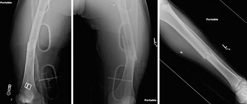 Bilateral midshaft displaced femur fractures (left) and left comminuted tibial fracture (right).