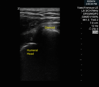 Image 1. Ultrasound of a dislocated shoulder, showing the characteristic empty space between the humeral head and the glenoid — the empty glenoid fossa.