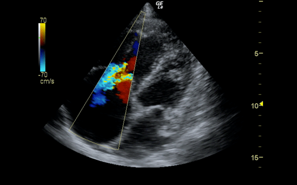 Ultrasound-Based Risk Stratification of Patients with Acute PE EMRA