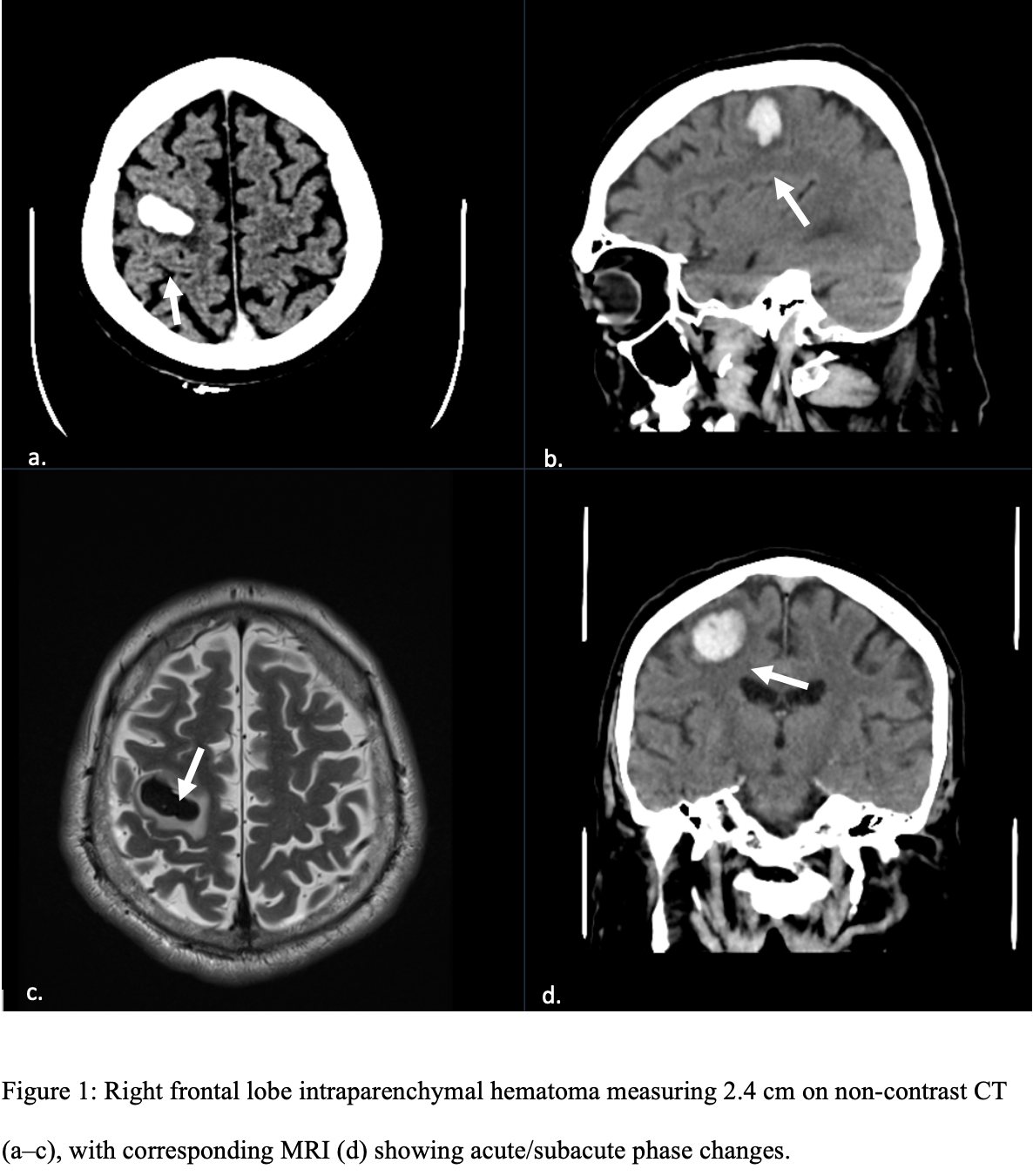 Atypical Stroke - Images.png