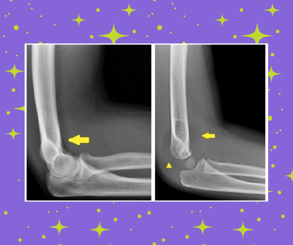 How to Approach the Pediatric Elbow