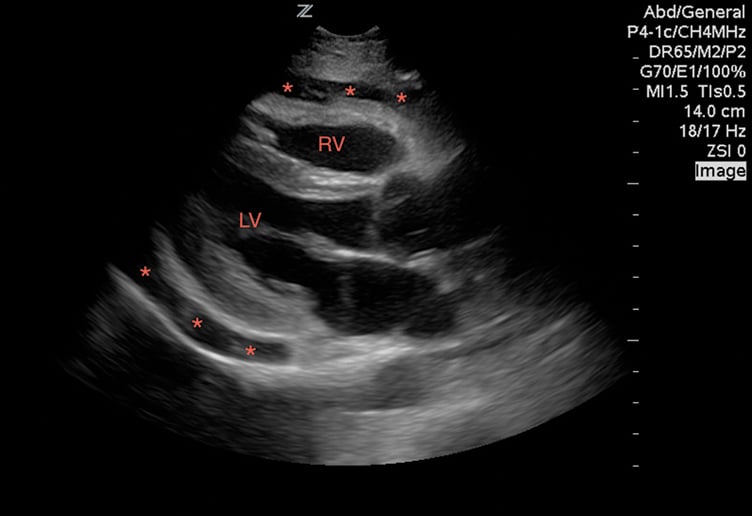 Image 1. A large pericardial effusion (*) with tamponade physiology.