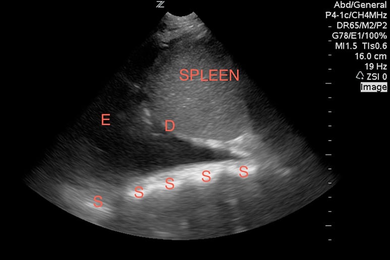 Image 10. A large pleural effusion (E) visualized above the diaphragm (D) with a spine sign (S).  A floating lung is not visualized in this image.