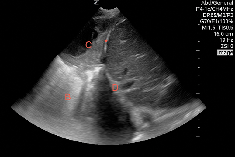 Image 11. A pulmonary consolidation (C) with a diffuse B-line pattern (B) visualized above the liver (L) and diaphragm (D).
