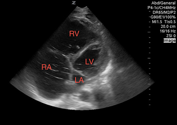 Image 3. A dilated right ventricle (RV) and atrium (RA), as compared to the left ventricle (LV) and atrium (LA). Seen in the setting of a pulmonary embolism.