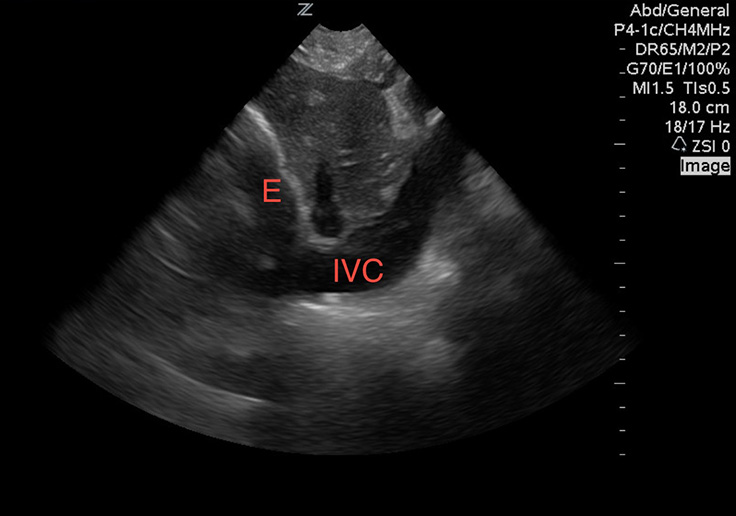 Image 4. A distended IVC with a pericardial effusion (E), consistent with tamponade physiology.