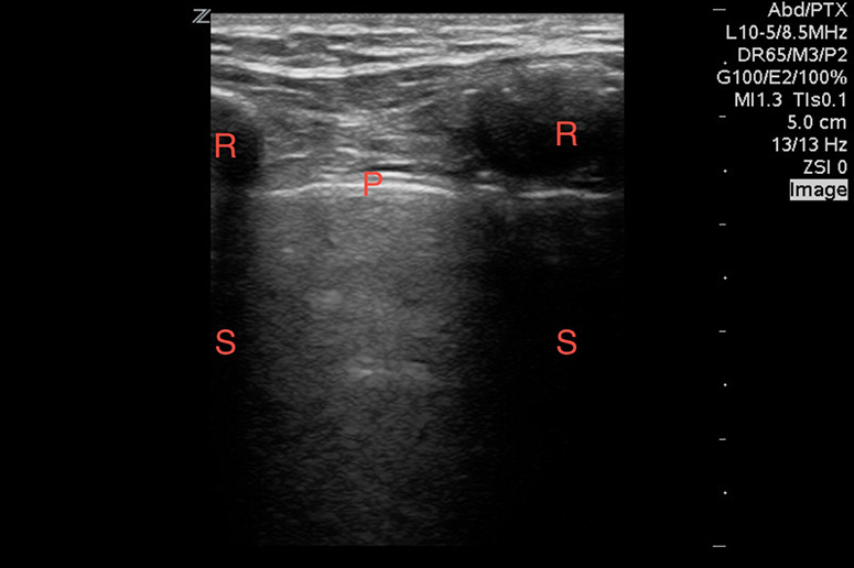Image 5. With the linear array probe, the pleura (P) can be seen sliding between two ribs (R), which demonstrates posterior shadowing (S).
