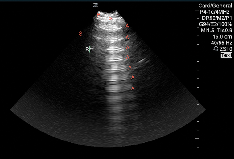 Image 8. Normal lung ultrasound, demonstrating A-lines (A) reverberating from the pleura (P) between two ribs (R).