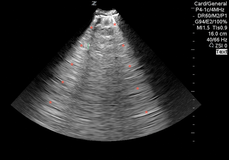 Image 9. Lung ultrasound on a patient with pulmonary edema and B-lines (*).
