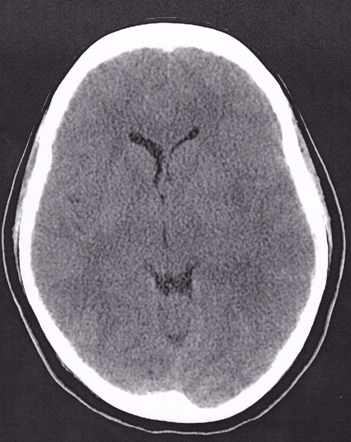 Image 1. A stat CT head demonstrates cerebral edema with some midline shift.