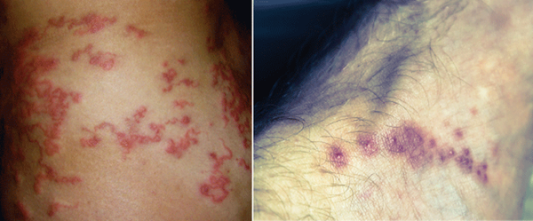 Foreign Travelers: Cutaneous Parasitic Infections from Abroad EMRA