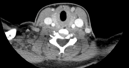 46-6 Case Report - Neck Swelling - image3.jpg