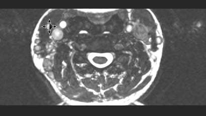 46-6 Case Report - Neck Swelling - image4.jpg