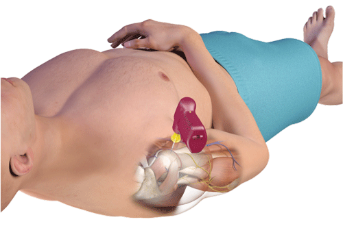 Figure 1. Note the correct positioning of the patient's arm, angle of the IO drill, and anatomical insertion site.