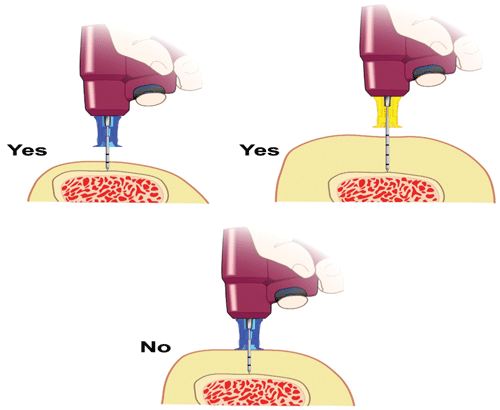 Figure 2. To properly insert the IO make sure to choose the correct size needle. There should be at least one black line above the skin (equivalent of 5 mm).