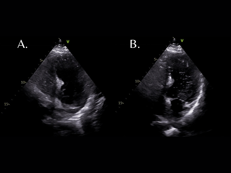 Platypnea-Orthodeoxia Syndrome - Fig 1.png