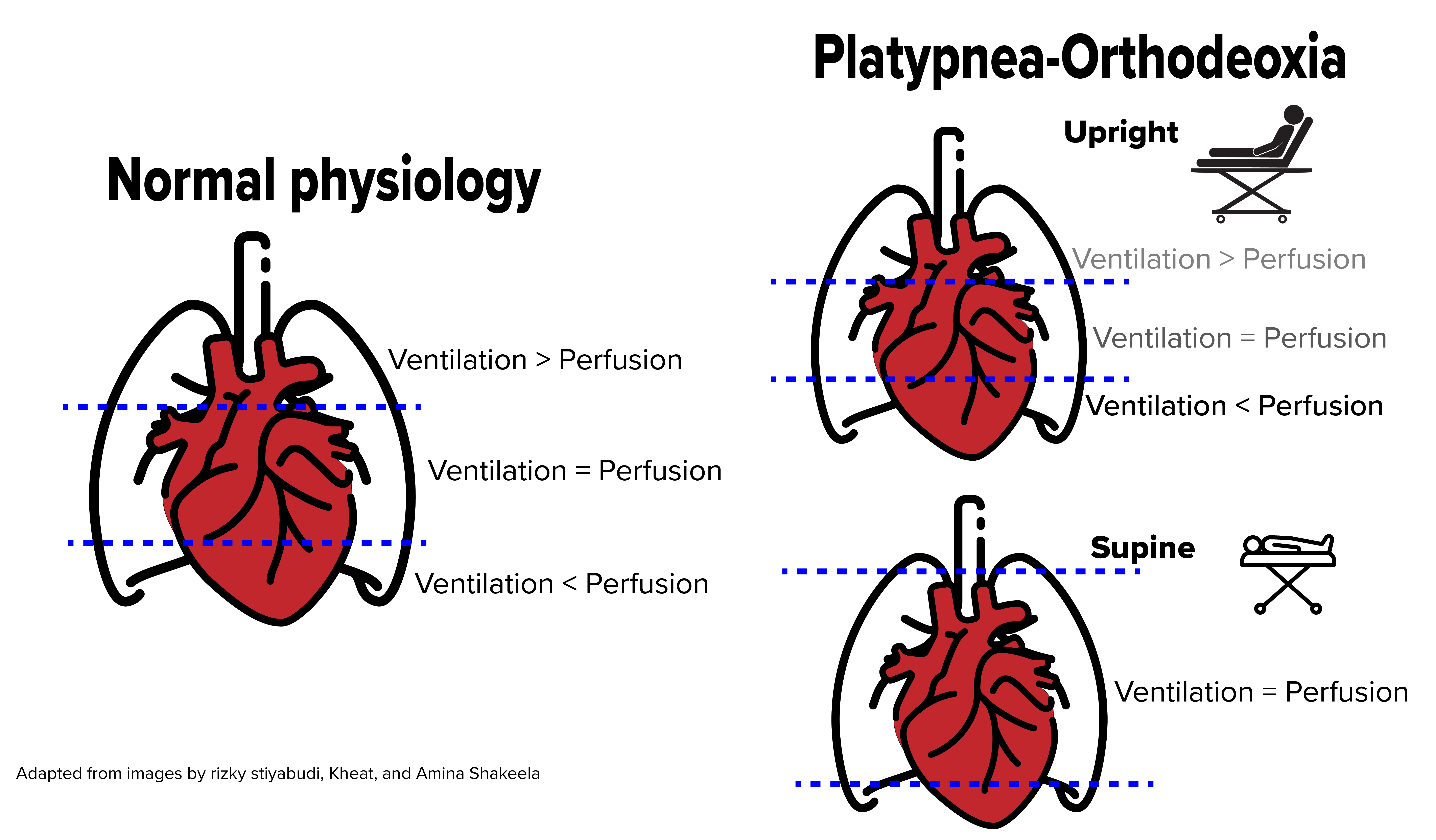Playtpnea-Orthodeoxia - Fig 2.png