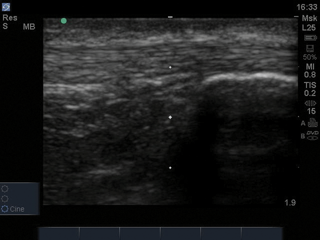 Image 2. Normal Achilles tendon in longitudinal view, just proximal to  insertion point.