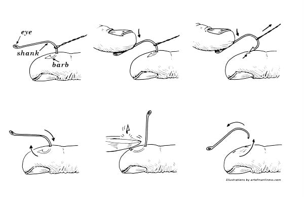 Angling for Success: Techniques for Fishhook Removal in the ED EMRA