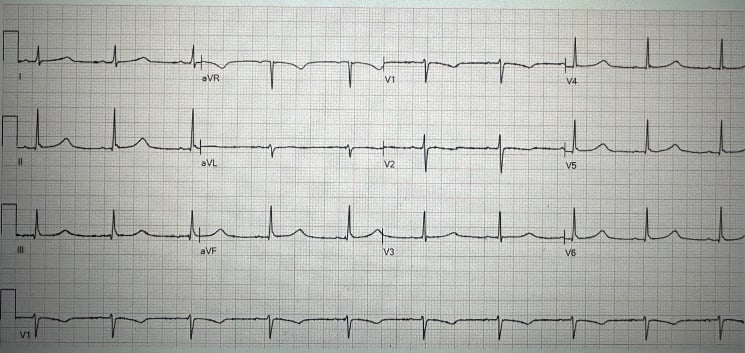 Takotsubo Cardiomyopathy - Image 1.jpg