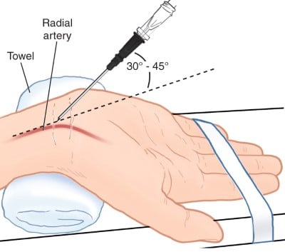 Figure 1. Arterial Puncture and Cannulation