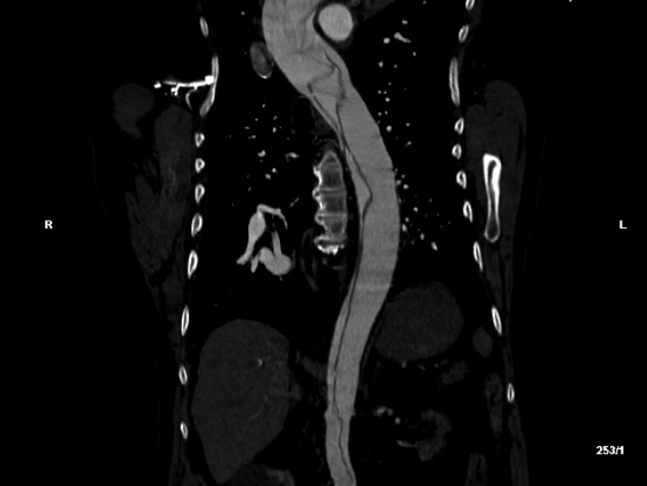 Aortic Dissection - Sagittal.png