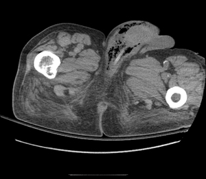 Image 2. CT imaging of the pelvis, revealing free air within the perineum and involving the genitals, consistent with necrotizing disease.