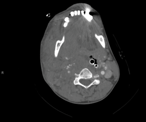 Image 1. CT angiogram demonstrating the projectile path and truncation of the carotid.