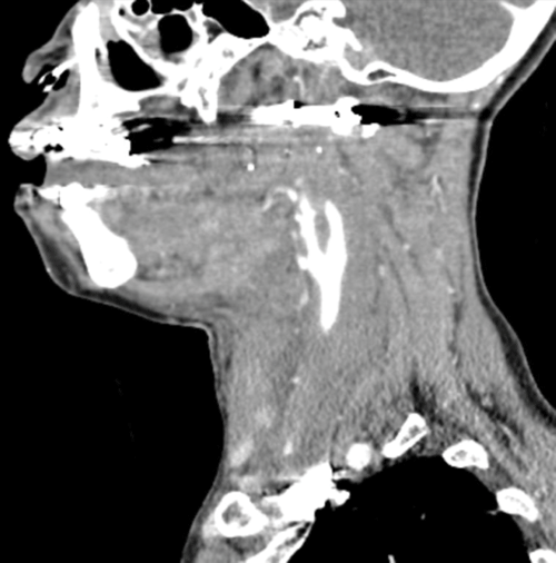 Image 2. Transverse cut of the CT angiogram which shows significant right-sided swelling with obscure vasculature and obvious displacement of the endotracheal tube.