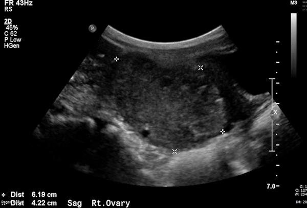 Figure 1. Ultrasound image of right ovary, with measurements indicating it's size. This ovary is enlarged, measuring at about 4 cm by 6 cm.