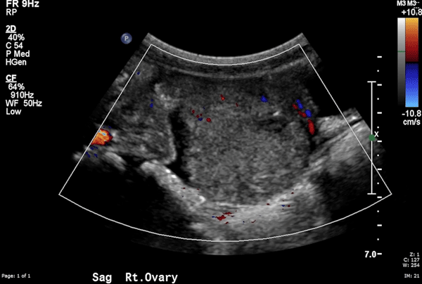 Figure 2. A color flow Doppler image of the right ovary.