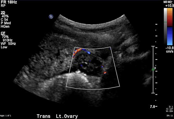 Figure 4. Color flow Doppler image of the left ovary.