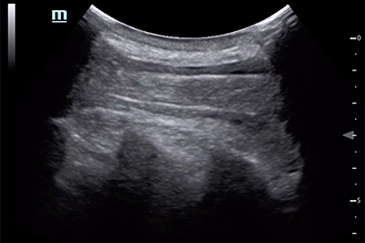 46-6 Ultrasound - Image 2 - espb-spinous-processes.jpg