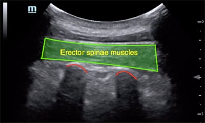 46-6 Ultrasound - Image 3a - erector-spinae-plane.jpg