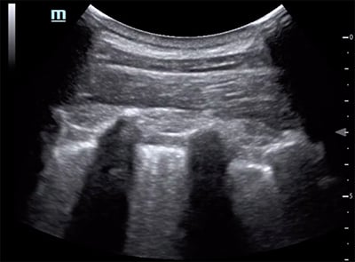 46-6 Ultrasound - Image 3b - erector-spinae-plane 2.jpg
