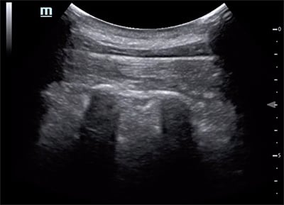 46-6 Ultrasound - Image 4 - espb-rounded-ribs.jpg