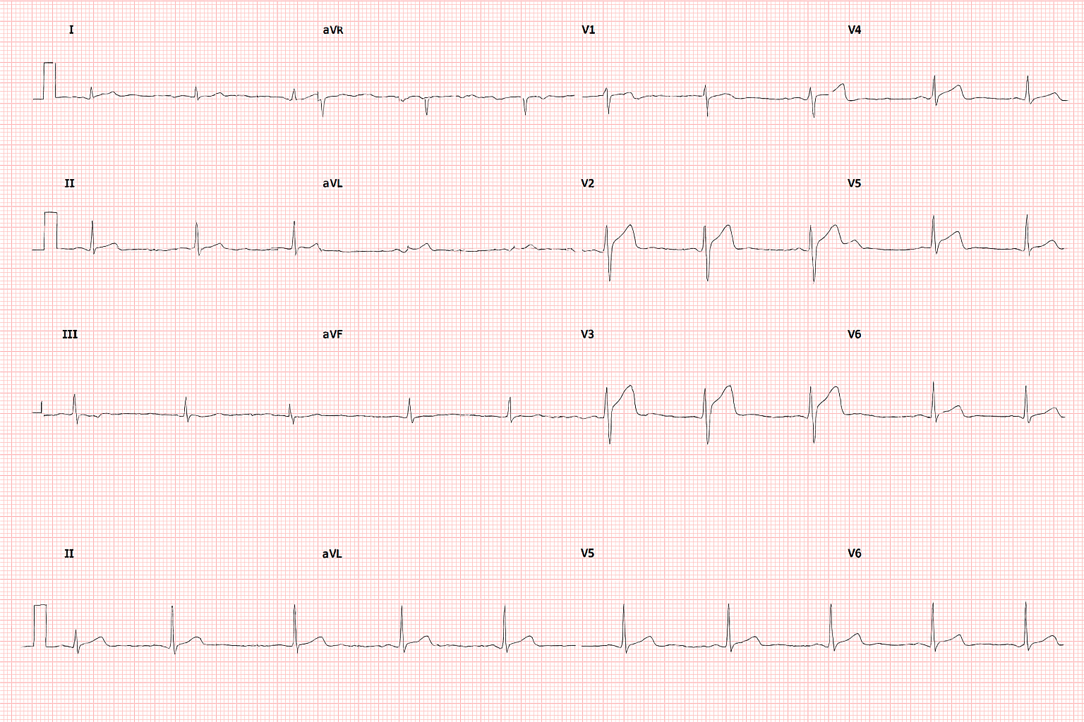 SCAD - EKG.png