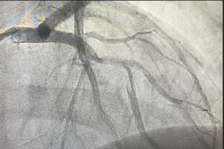SCAD - Fig 1 - angiogram-revealing-dissection.png
