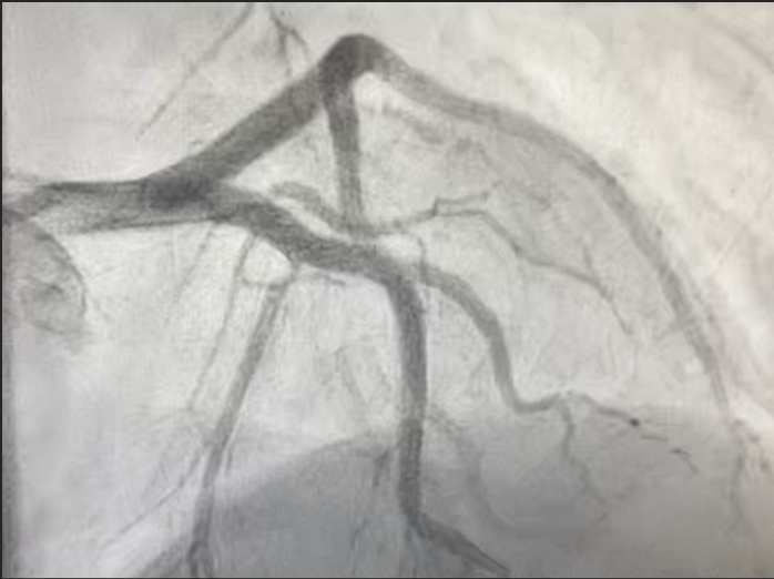 SCAD - Fig 2 - post-stenting-angiogram.png