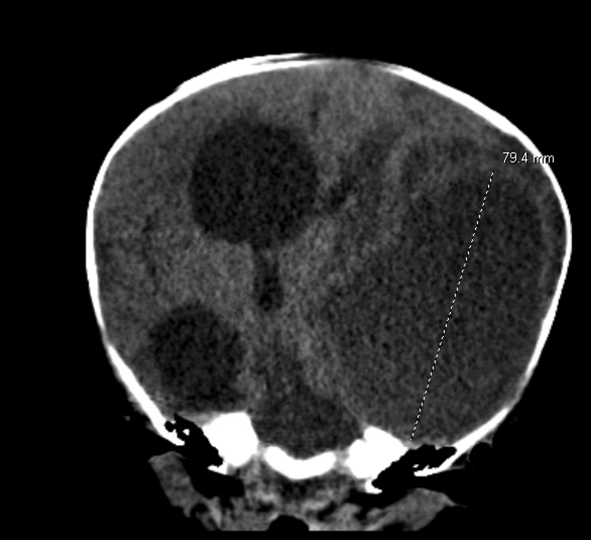 Pediatric Brain Abscess - Fig 2.png