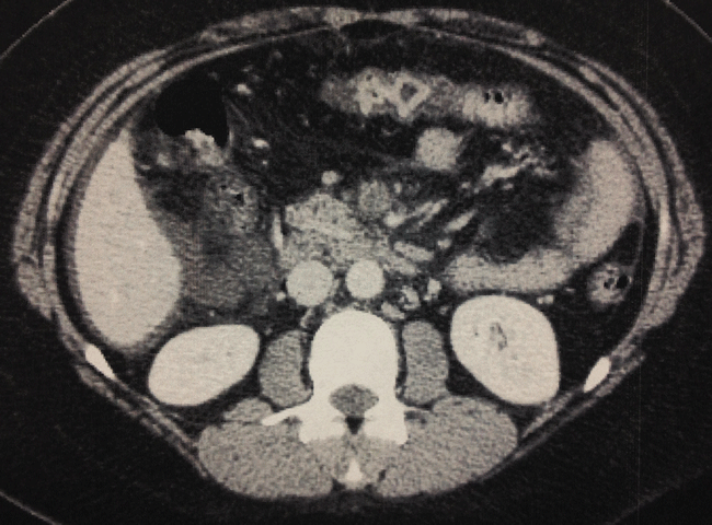 Figure 1. Contrast-enhanced computed tomography imaging of the abdomen shows superior mesenteric vein occlusion, extended from the portal vein.