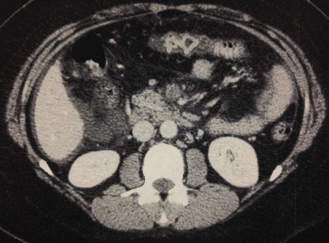 Figure 1 Figure 1. Contrast-enhanced computed tomography imaging of the abdomen shows superior mesenteric vein occlusion, extended from the portal vein.